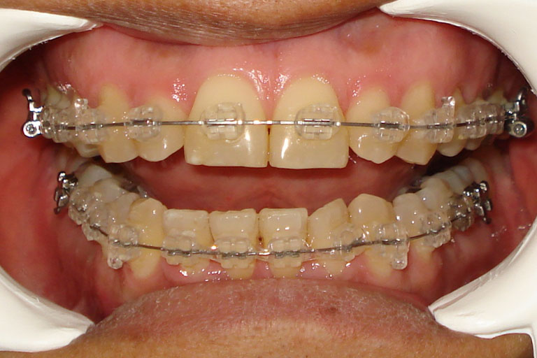 Beneficios de los Tratamientos Dentales Estéticos.